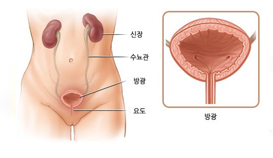 방광염 원인