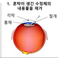 백내장 초기증상