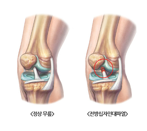 무릎십자인대파열