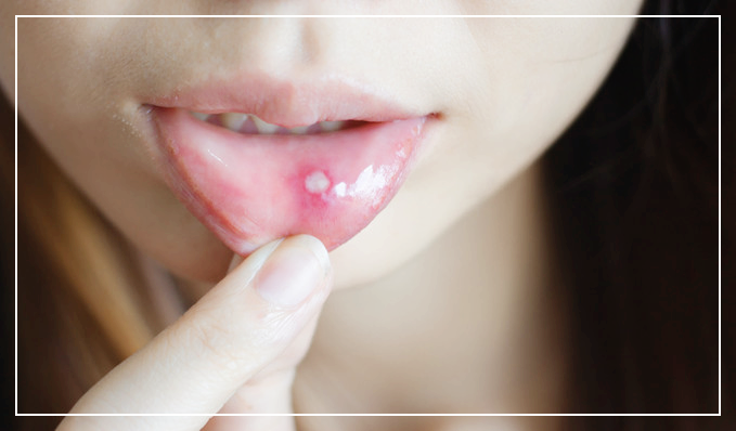 구내염에-좋은-음식