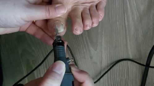 발톱 무좀 치료