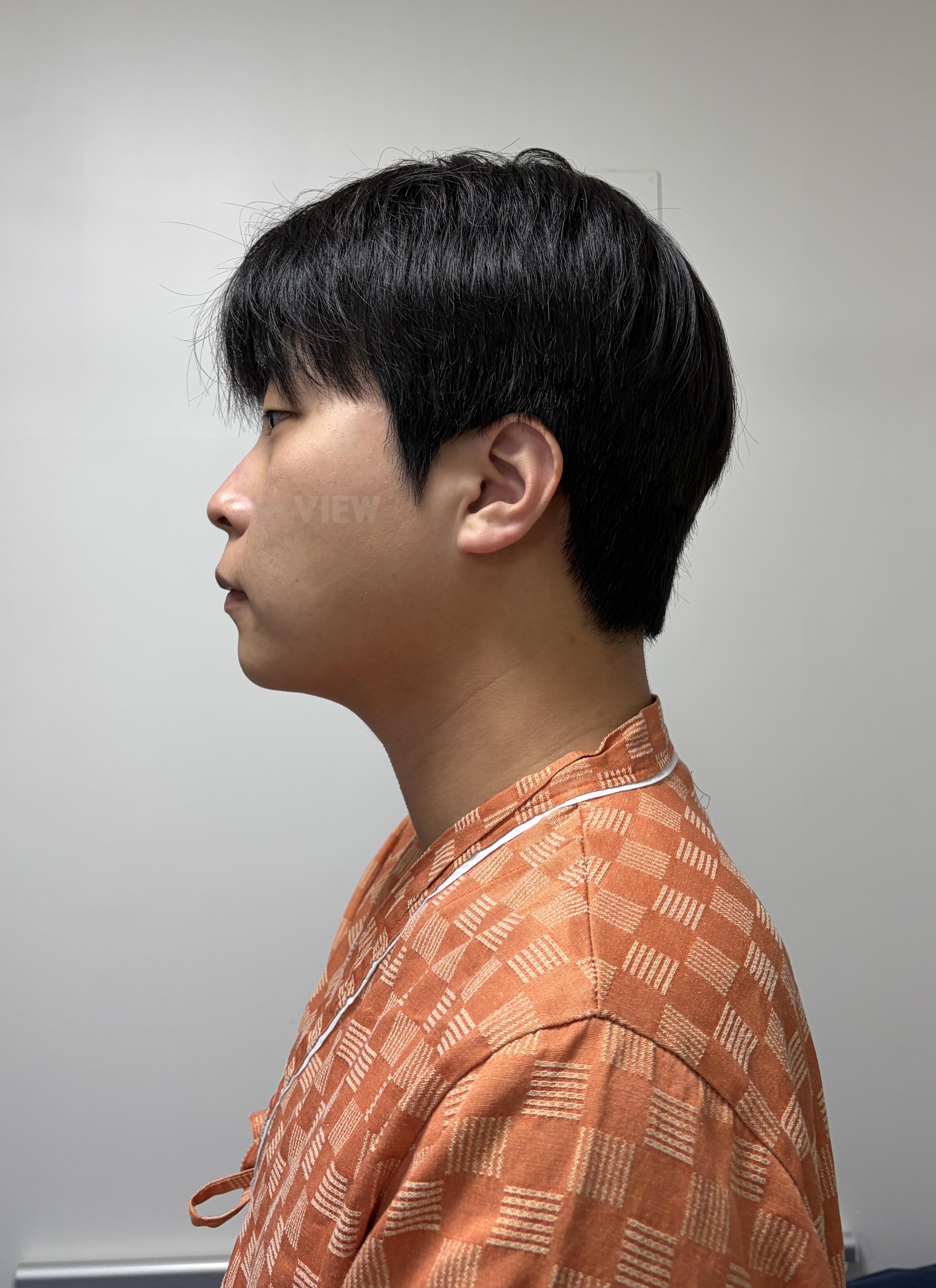 Bader Rhinoplasty Plastic Surgery in Korea Review: Korean Rhinoplasty Results