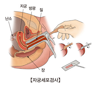 자궁경부암 증상부터 원인, 치료