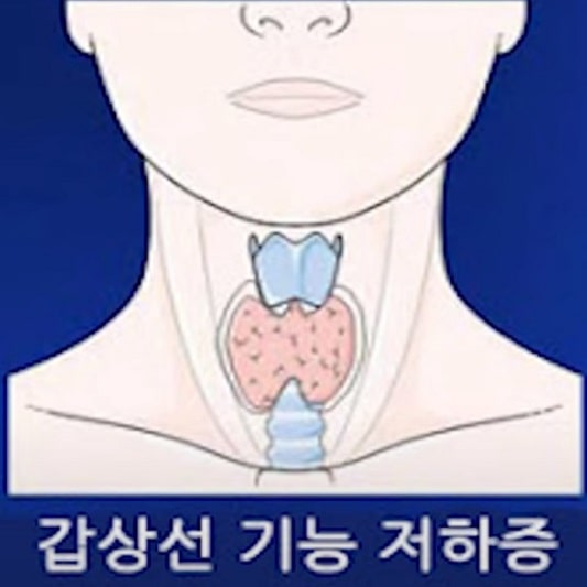 갑상선 기능 저하증 증상