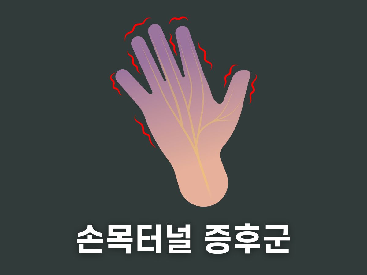 손목터널 증후군