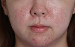얼굴에 나타나는 주사 현상
