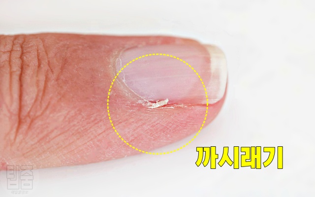 손톱 주변 살, 까시래기 거스러미,손톱 옆 갈라짐 염증,건강 팁줌 매일꿀정보
