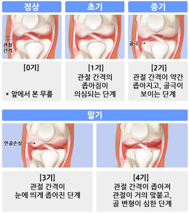 관절염의 원인과 증상