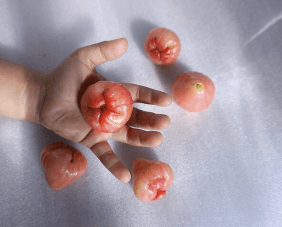 치질의 증상과 치질 자가치료법, 치질 예방법 요약정리