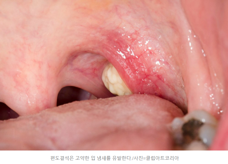 편도결석이 목구멍 아래에서 나오는 모습이 보인다.