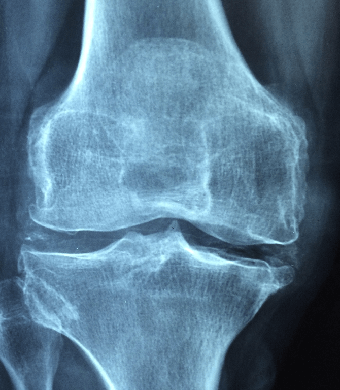 칼슘 부족과 관련된 사진 - 7