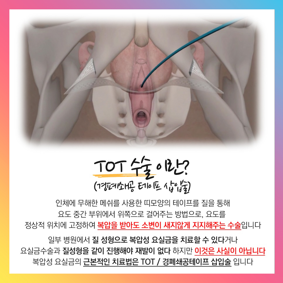 TOT수술이란