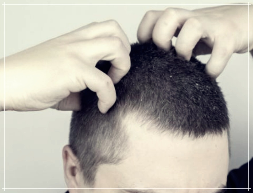 두피땀 원인으로 탈모가 생긴다면?