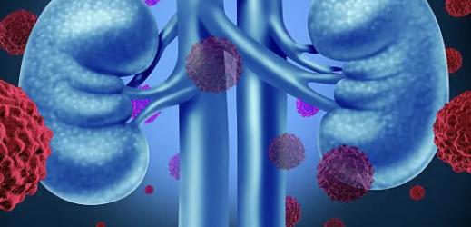 단백뇨의 원인 27