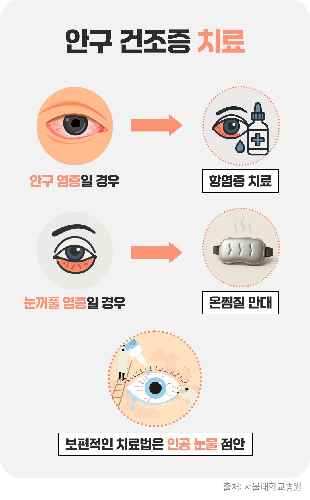 #안구 건조증 치료방법