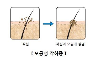 모공각화증 사진