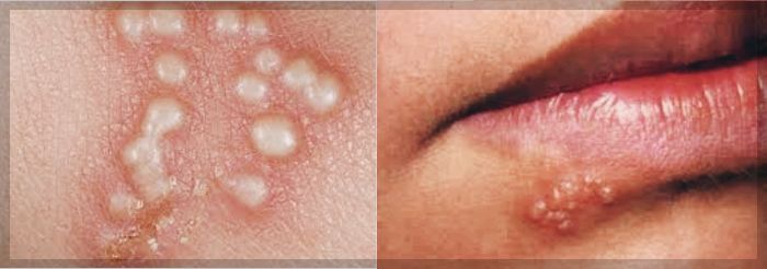 헤르페스-입술수포사진