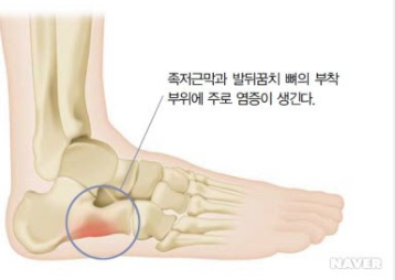 족저근막염