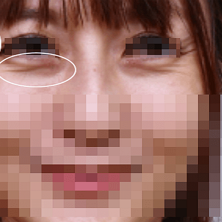 눈밑지방재배치 수술 하기 전 여성의 모습