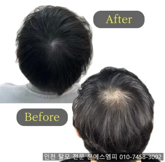 정수리가 아픈 이유와 완화하는 방법_32