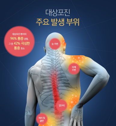 대상포진 초기증상