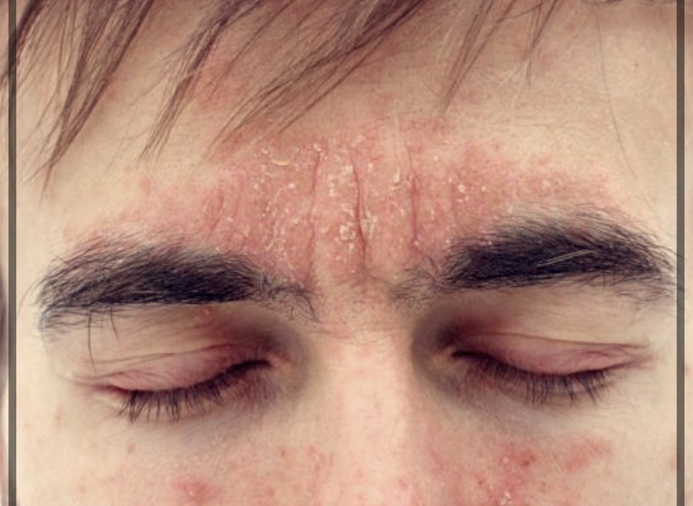 화폐성 피부염 치료방법에 대한 이해