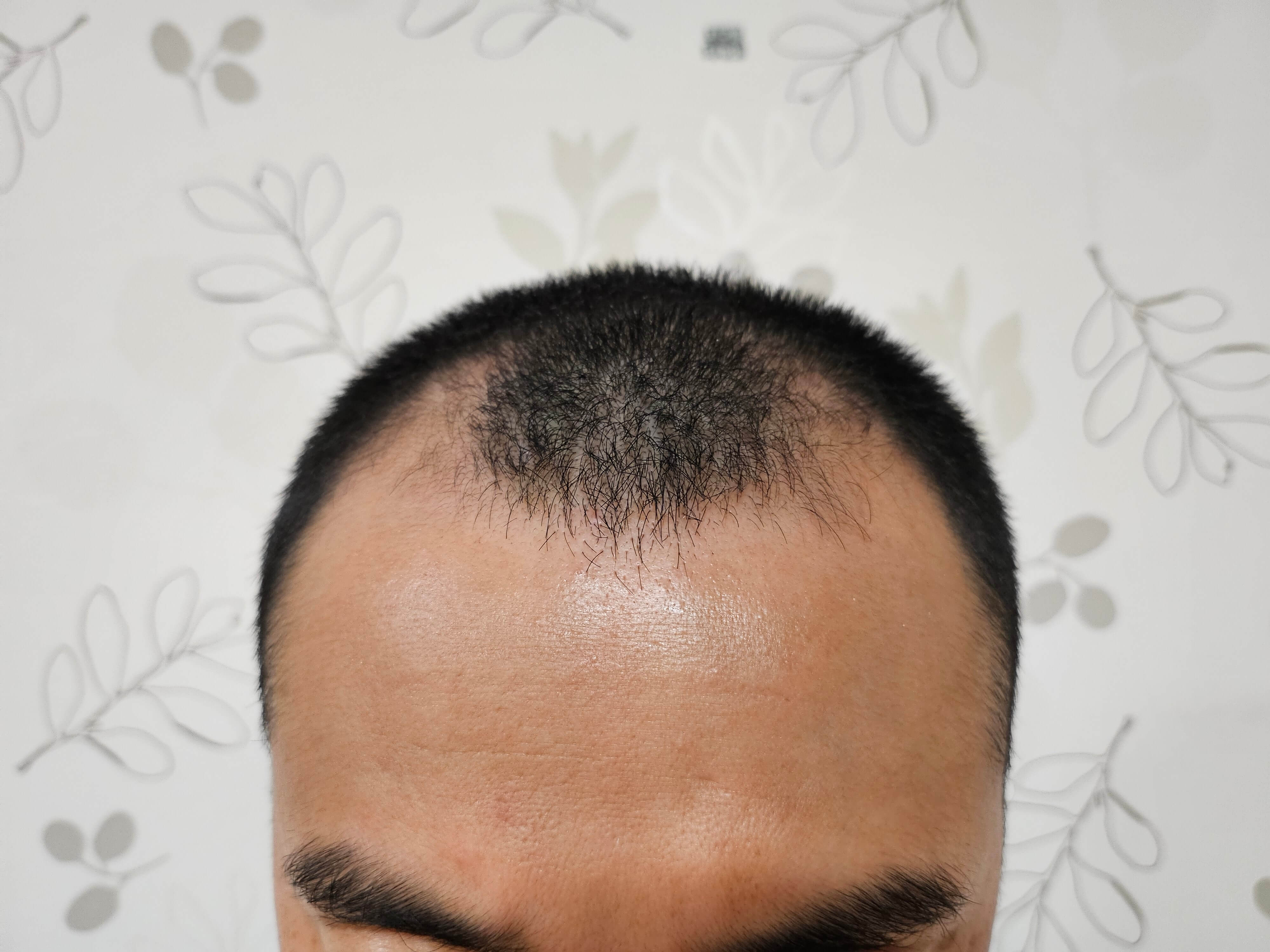 M자 탈모 진행중