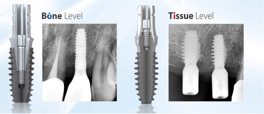 덴티움-임플란트
