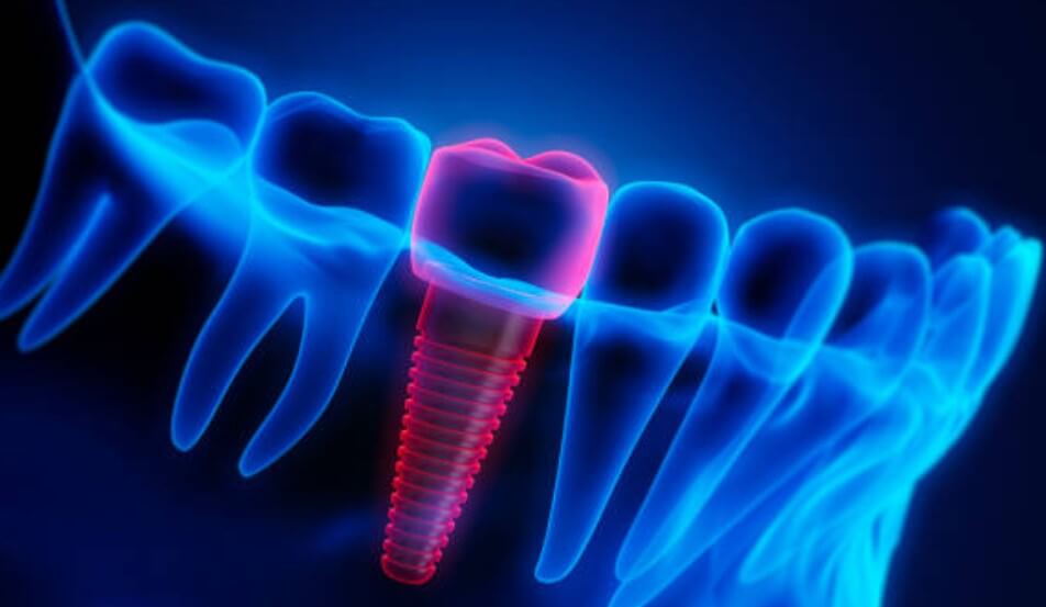 임플란트 시술기간