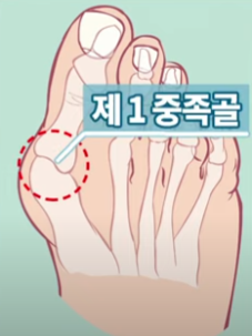 무지외반증 초간단 치료법&amp;#44; 무지외반증 교정기