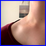 화이자 임파선염 쇄골 멍울 썸네일 이미지