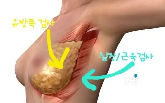 여자 오른쪽 겨드랑이 콕콕 유방암 증상일까 놓치기 쉬운 신호로_7