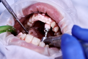 1차 수술 후 회복 기간