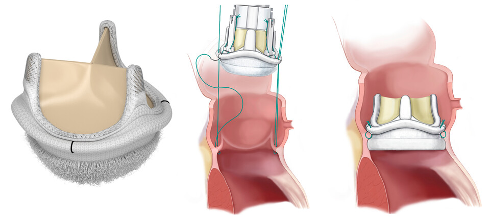인공판막 치환술 수술 입원기간