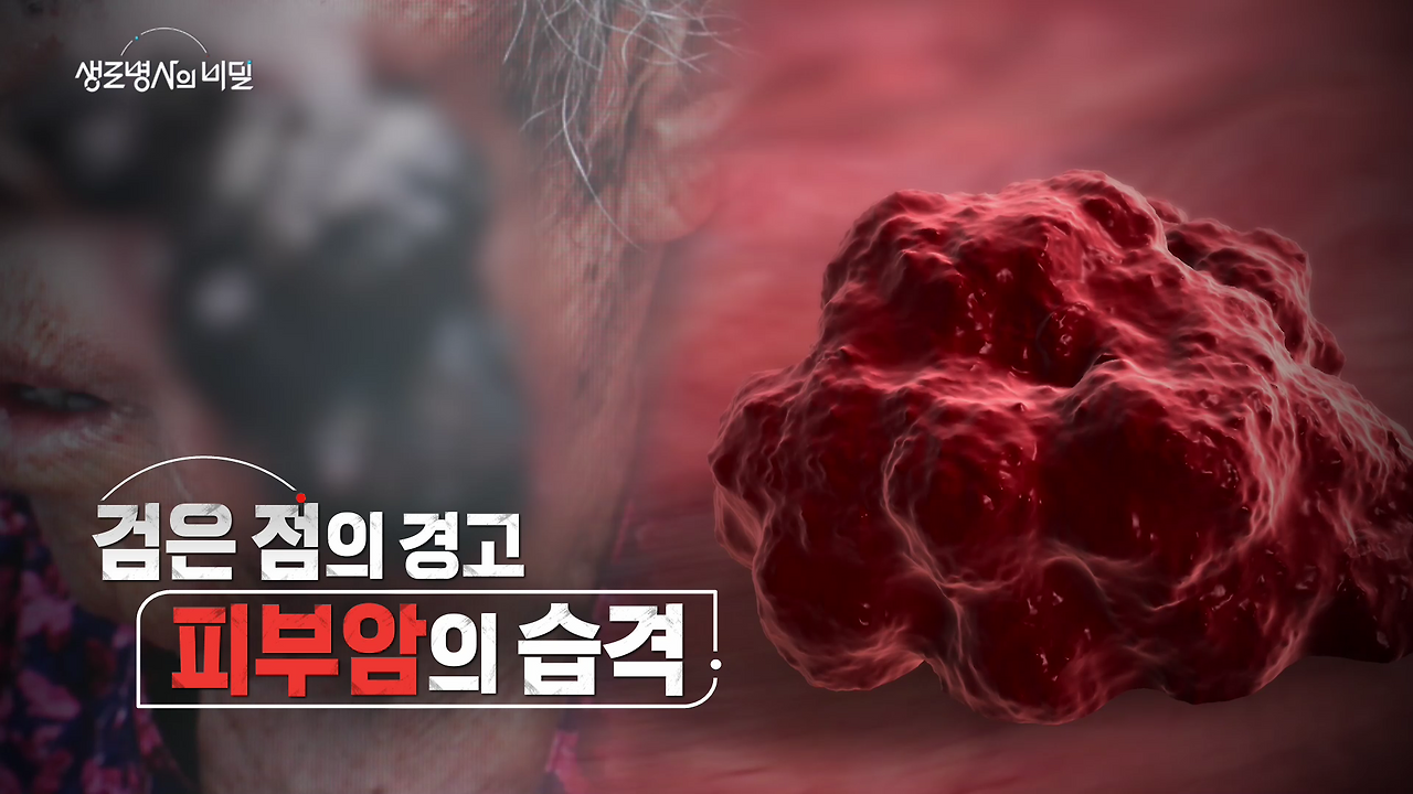 생로병사의 비밀 피부암 검은점