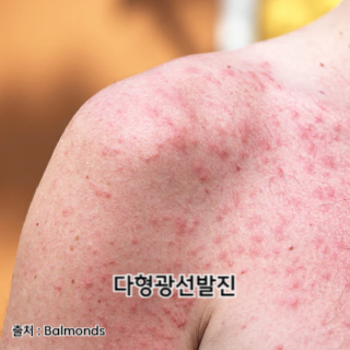 햇빛-알레르기-증상