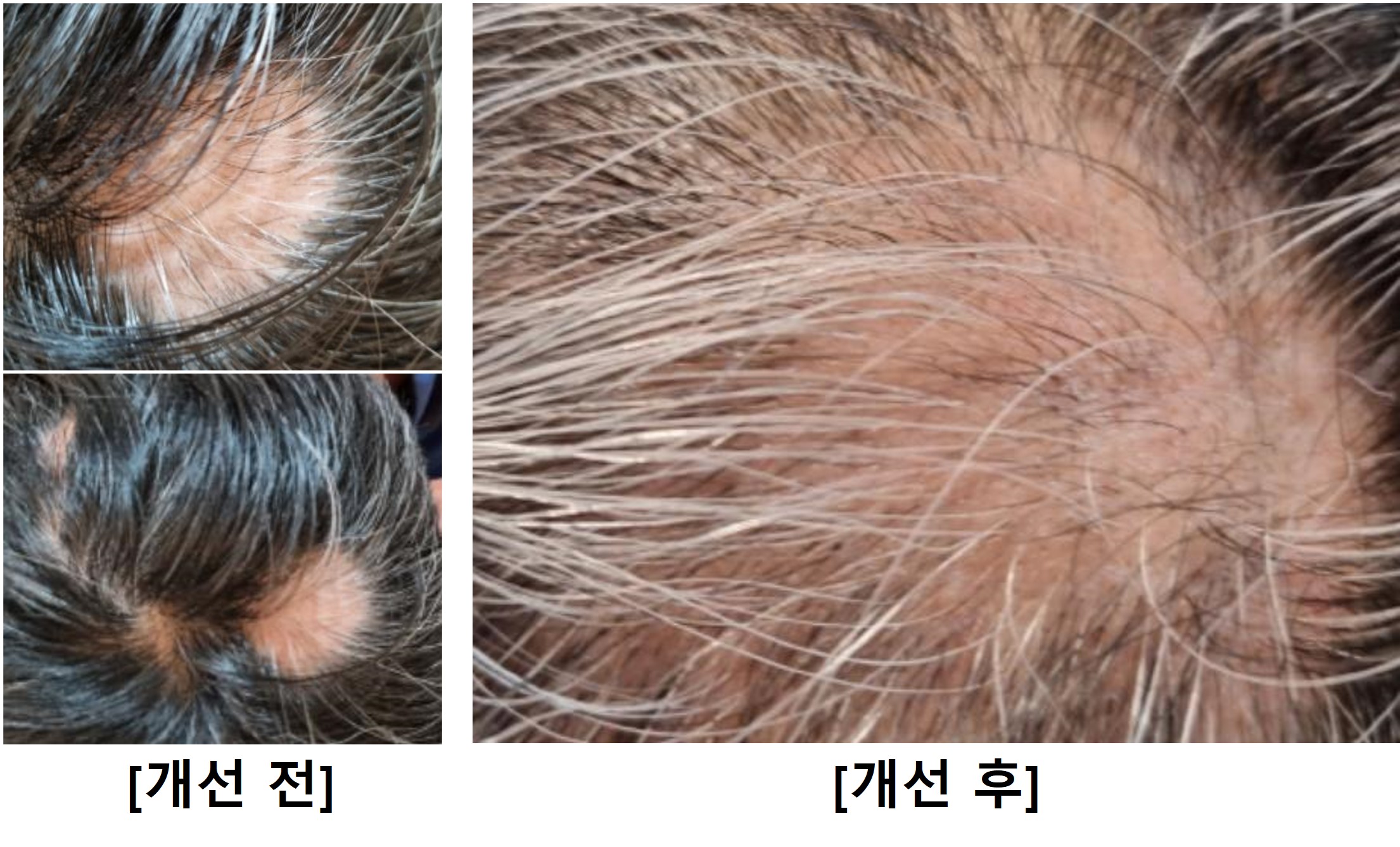 원형탈모 오일 사용 후기 3 이미지