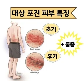 경기도 대상포진 무료접종 연령 기준 정리로 안내_17