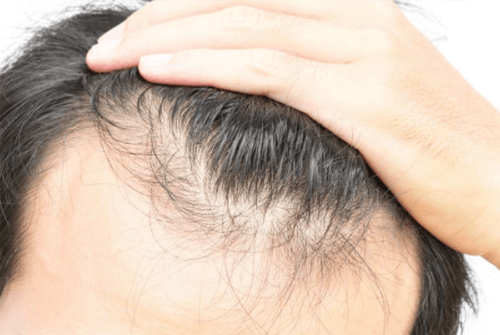 탈모에 좋은 음식01