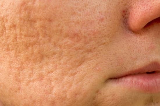 모공 흉터 치료: 원인, 치료 방법, 관리법