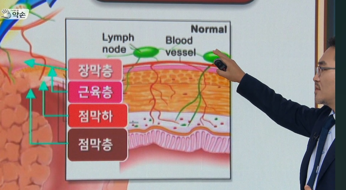 직장암-항문-명의-김진-교수-대장항문외과