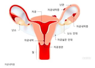 자궁내막증 