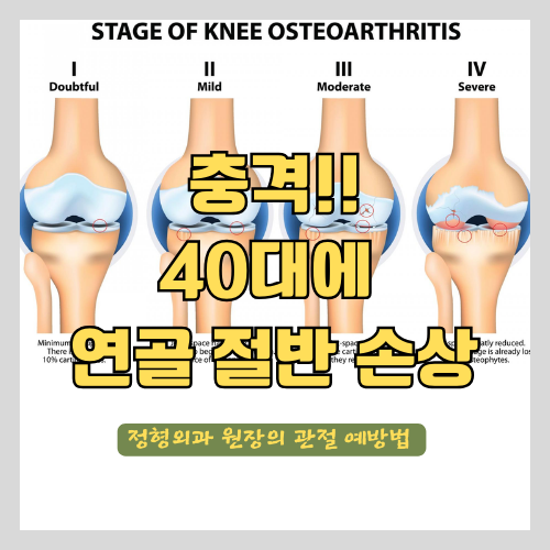 40대에 연골 절반이 사라진다고? 썸네일
