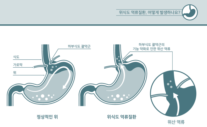 역류성 식도염 목 이물감&amp;#44; 가래가 낀 것처럼 느껴지는 이유