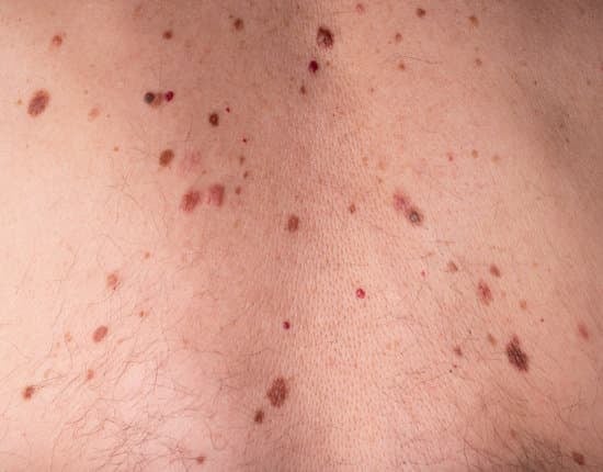 화염상 모반 (Nevus flammeus): 원인과 치료 방법