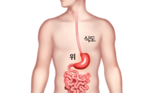 위암 이미지