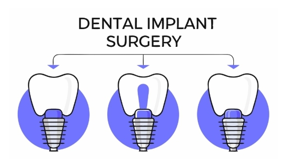 임플란트 수술과정