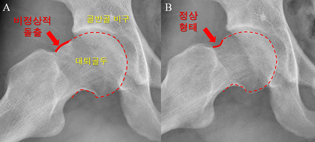 고관절 충돌 증후군의 뼈 사진과 정상 뼈 사진 비교