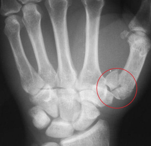 Ronaldo 골절의 단순방사선 영상검사 사진