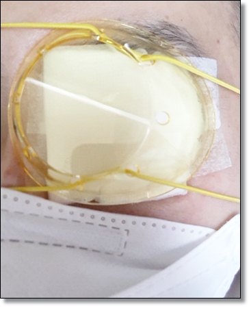 망막전막-유리체절제술-후기-과정-비용